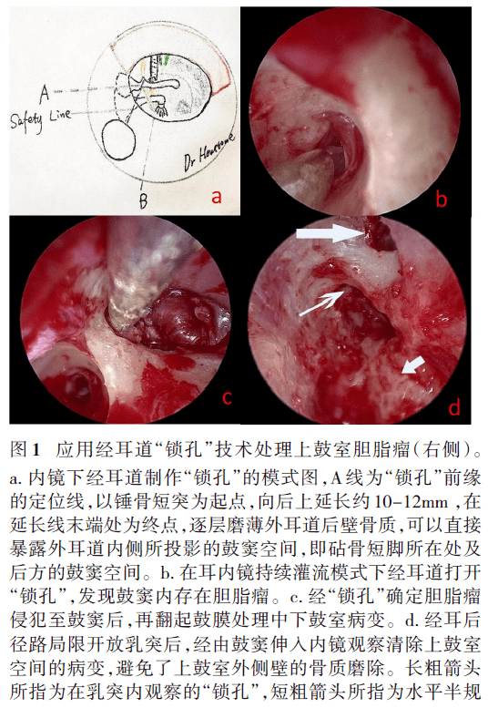 耳内镜下外耳道锁孔技术处理累及乳突的中耳胆脂瘤的初步实践