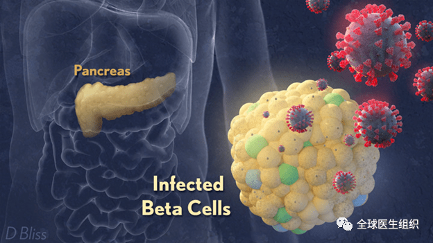 必读|最新研究证实新冠病毒感染后诱发糖尿病激增