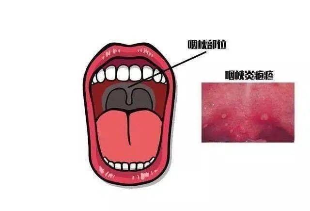 那疱疹性咽峡炎该如何预防呢?