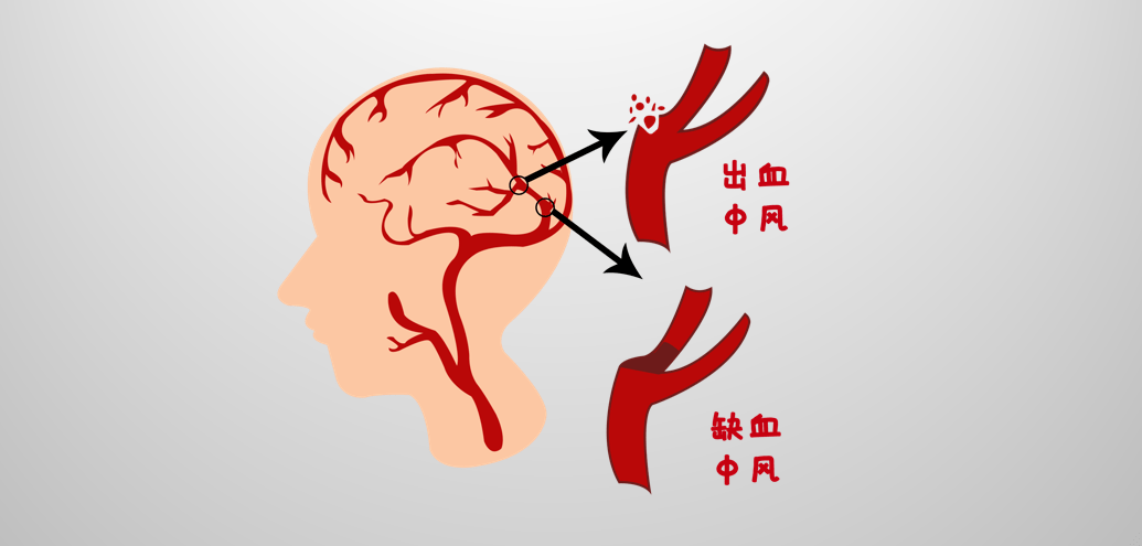 中风,包括出血性中风(脑出血)和缺血性中风(脑梗死,具有高发病率,高