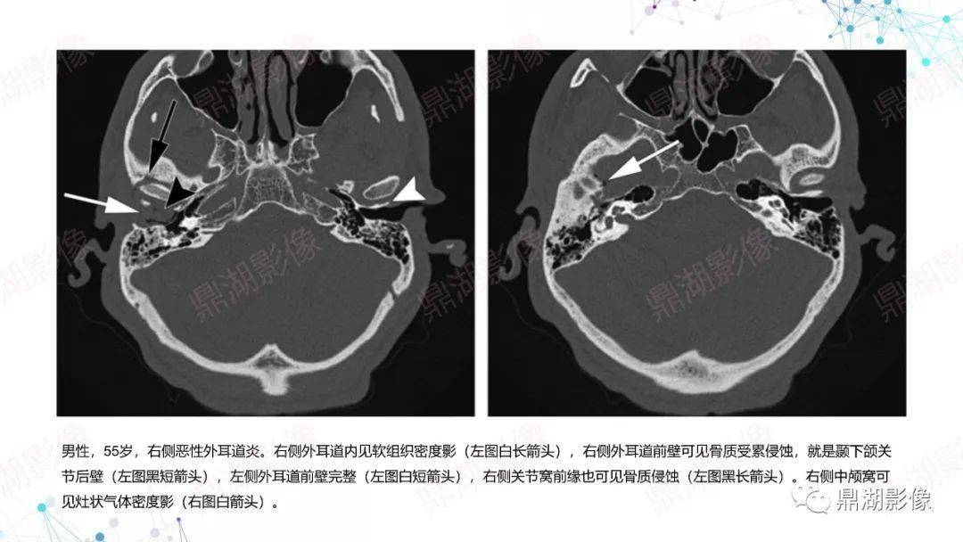 图解颈部ct影像阅片及诊断报告要点