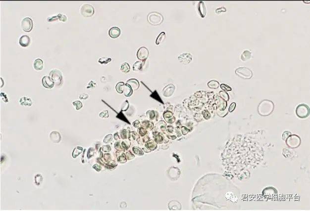 粘液丝未未完待续浆膜腔积液细胞形态学检验专家共识(2020版)支气管