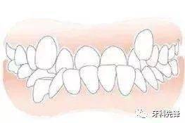 "发现即矫正"12岁前必须处理的20种儿童牙颌畸形