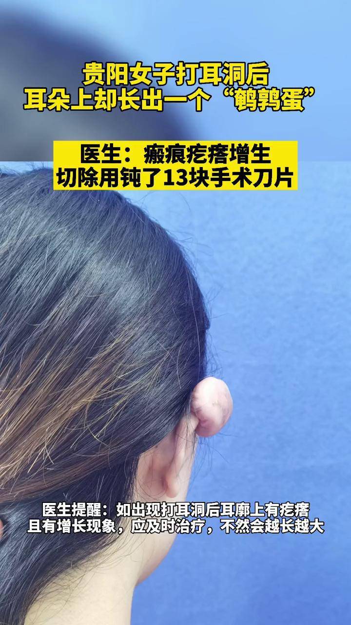 女子打耳洞后长出鸽子蛋大的疙瘩