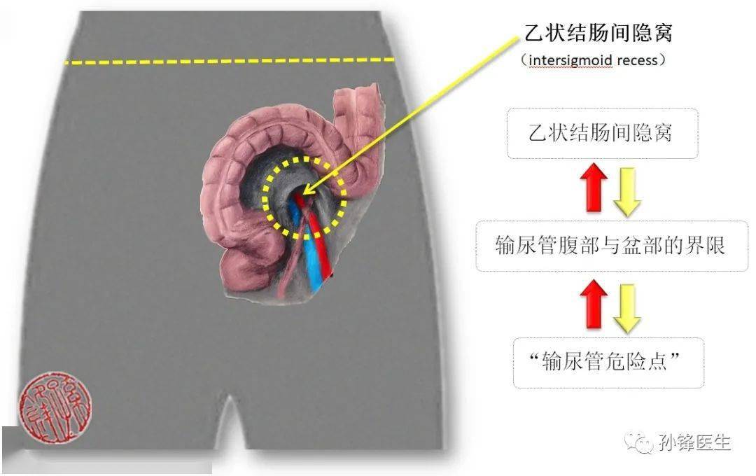 医学笔记|"输尿管盆部"保护的应用解剖(图文)_直肠