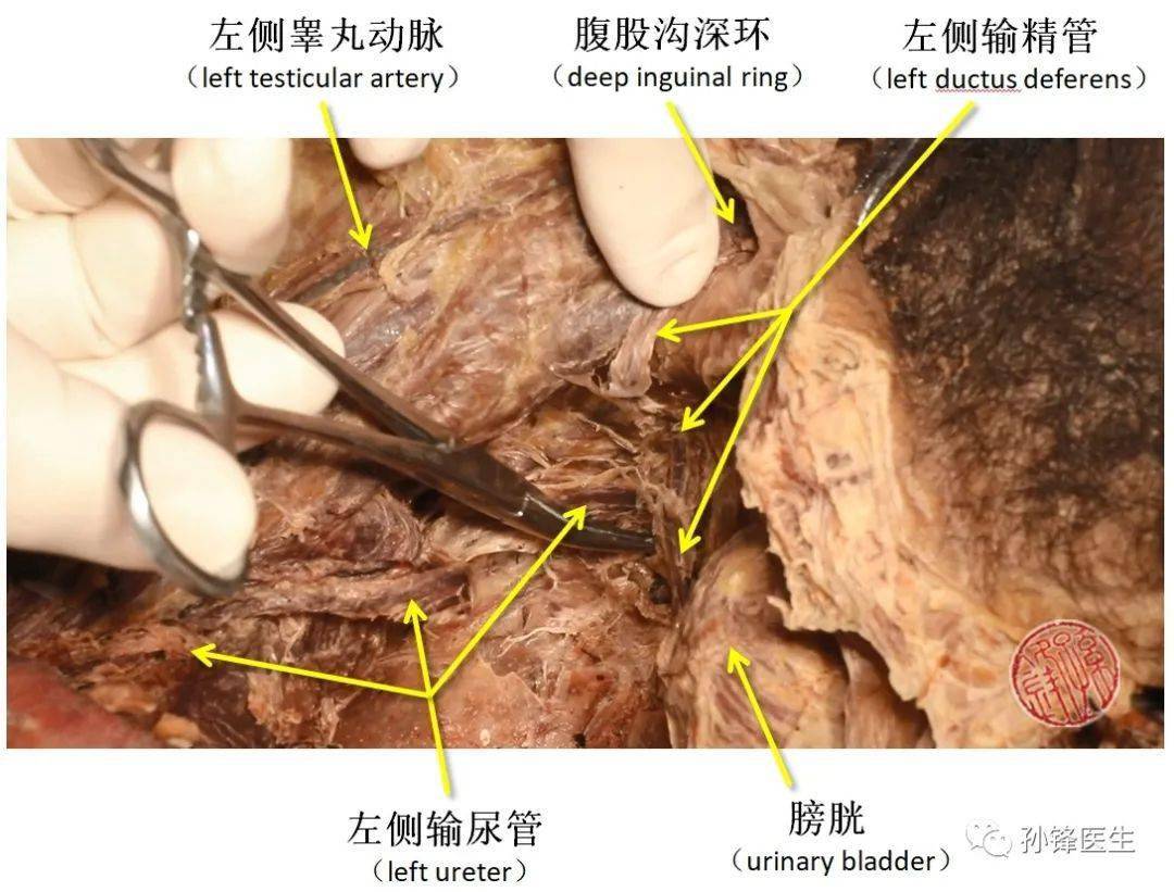 左侧输尿管与左侧输精管的交叉点↑↑↑女性输尿管盆部位于卵巢的后