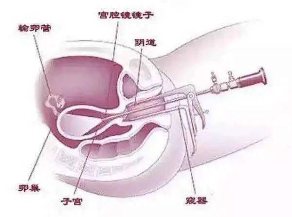 诊断更准确 我是一种高科技纤维光源内窥镜,内含有宫腔镜,能源系统