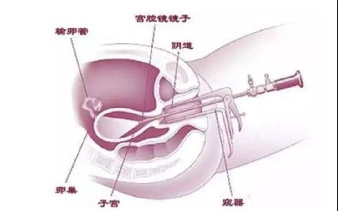 如果诊刮发现是子宫内膜癌前病变,子宫内膜不典型增长,需做进一步