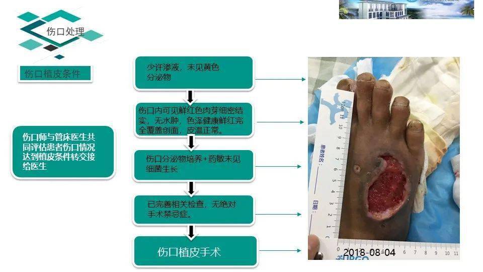 一例右足背部伤口的护理