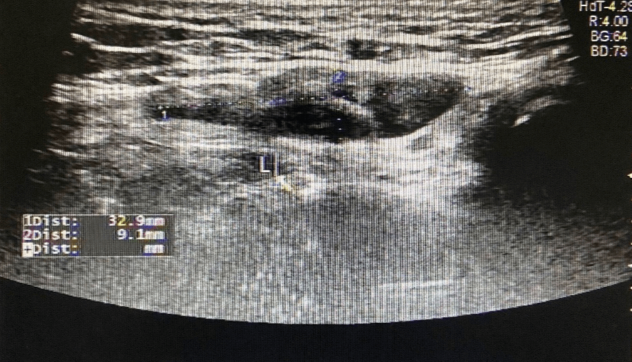 女性腹股沟处的包块除了疝气还可能是什么呢