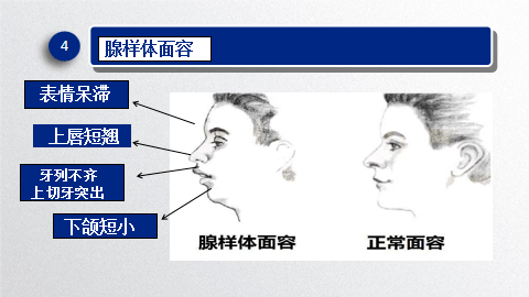 鼻中隔偏曲等,面部肌肉不易活动,缺乏表情,医学上称之为"腺样体面容"