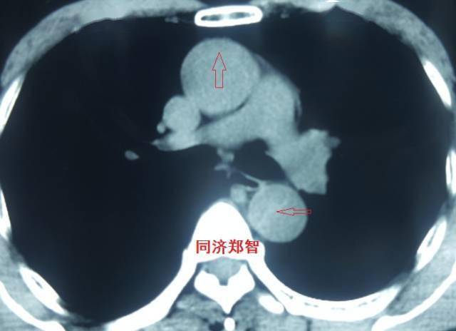 没有cta这三招也能识别主动脉夹层