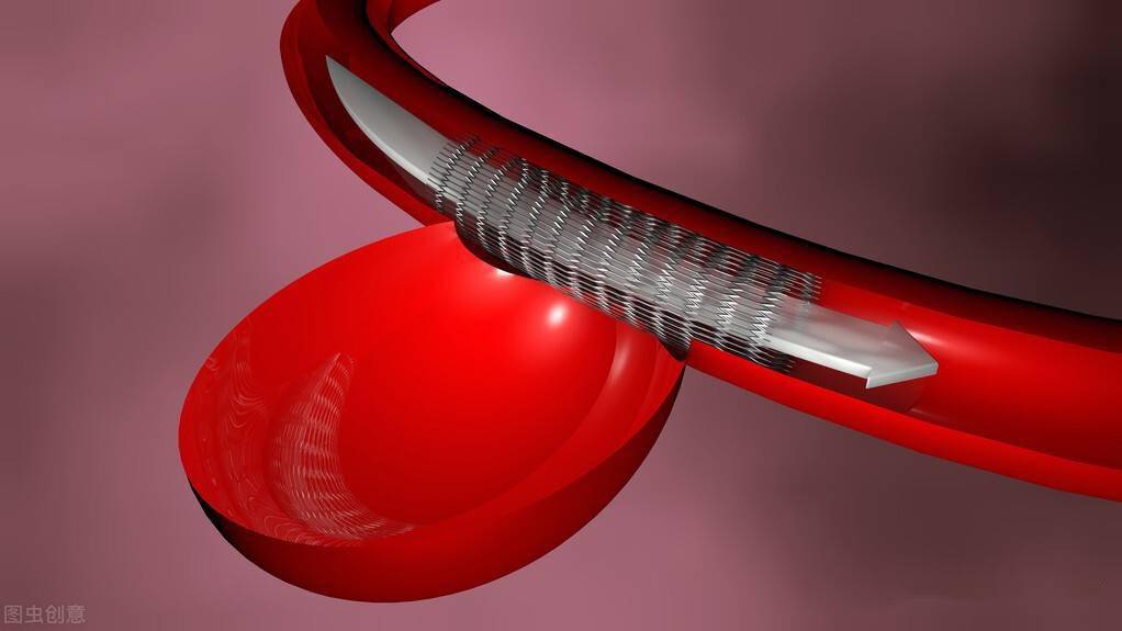 iliac vein,veinminer long-term efficacy of endovascular treatment of isolated iliac