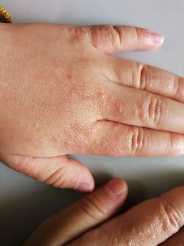 这3 种儿科皮肤病都和摩擦有关,怎么处理?