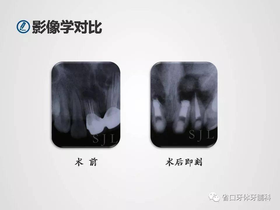 【病例分享】上颌前牙区显微根尖手术一例