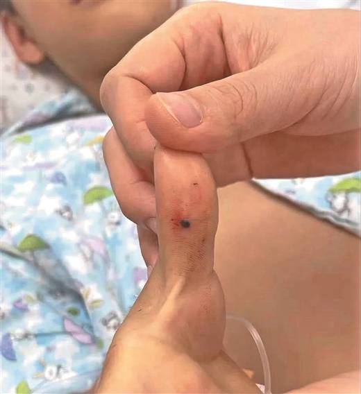 瘀斑并逐渐增大形成血肿,拇指上还有一处小伤口渗血不止…7月17日晚