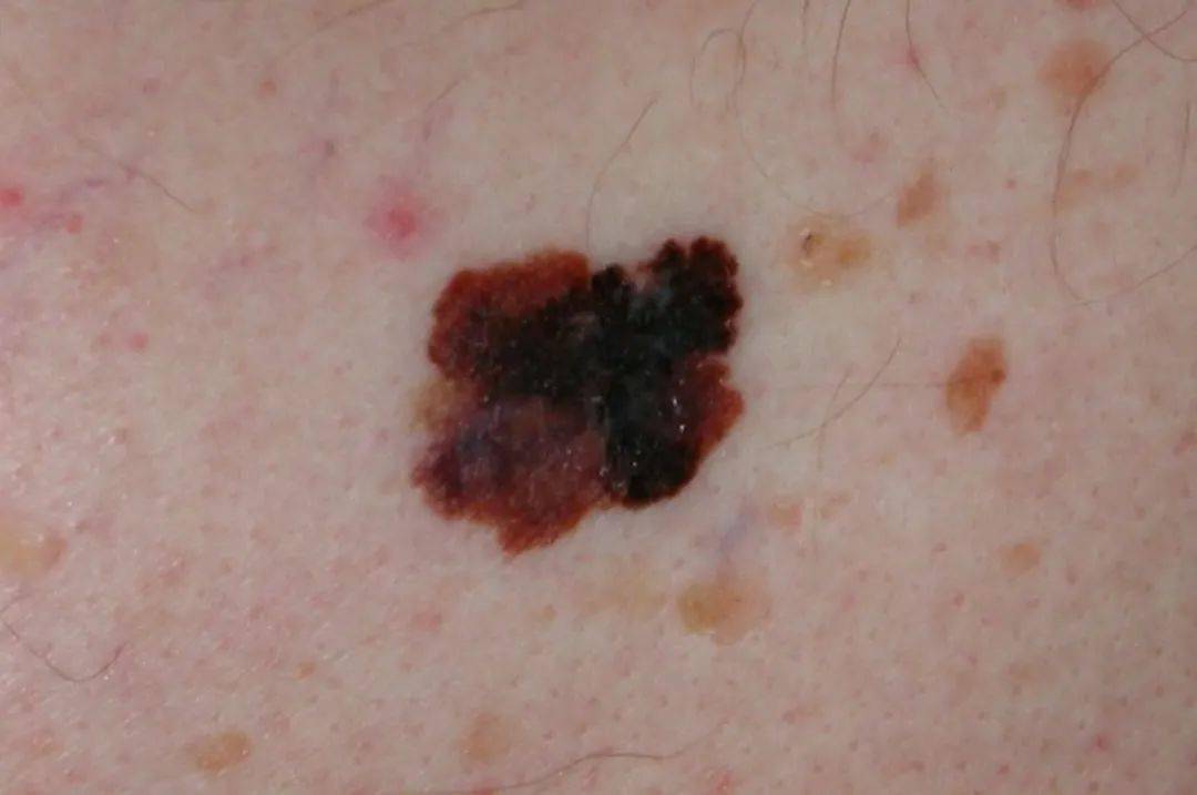 恶性伤口-黑色素瘤