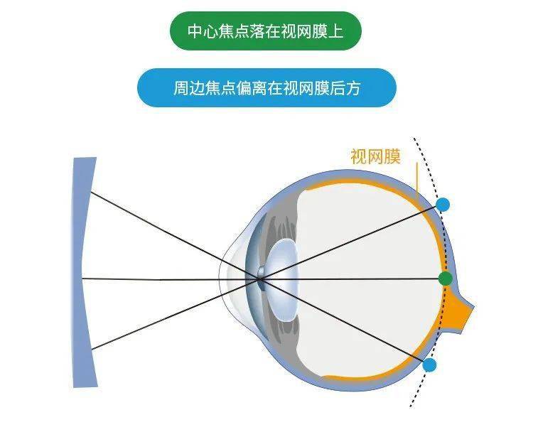 警惕中国儿童近视率高达536配这副眼镜可防控近视度数涨了无忧退换