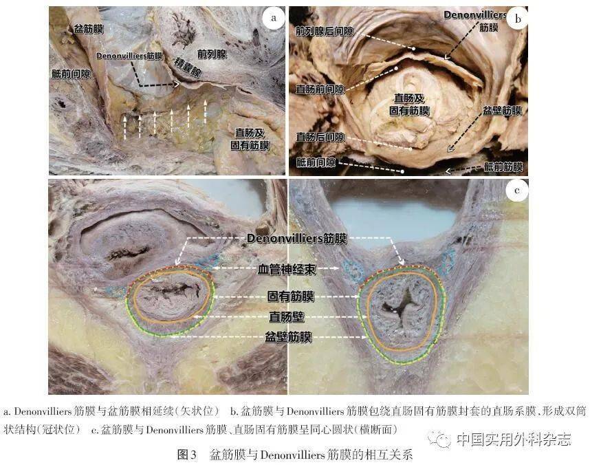 论著| 盆筋膜解剖及其与直肠固有筋膜关系研究