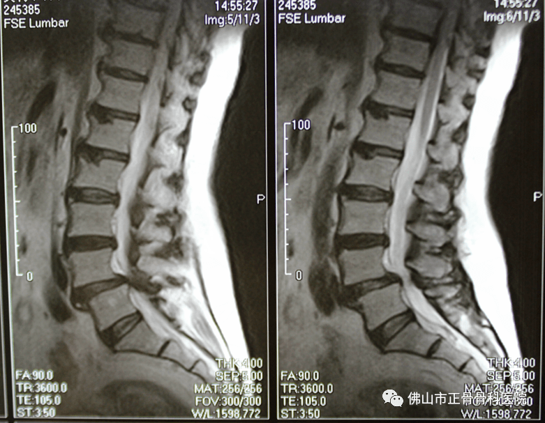 腰椎管狭窄症是指各种原因引起腰椎神经通道狭窄而产生临床症状的一