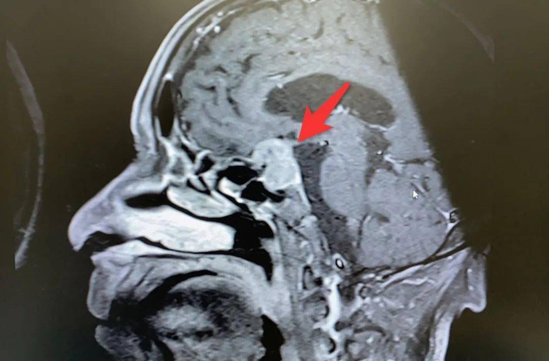 垂体肿瘤生长过程中,  一旦压迫视神经就特别  容易出现视野缺损及