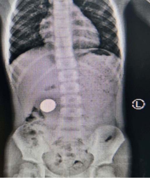 经x线检查发现,小余右侧中腹部见"硬币"样消化道