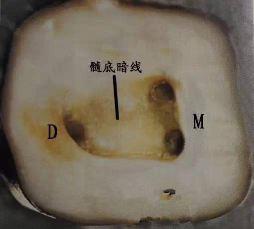 髓腔和根管口的解剖规律 :"根管口"寻找