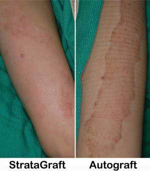 首款"人造皮肤"获批,用于治疗重度烧伤,不用再植皮了