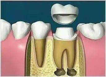 什么是根管治疗和打桩做冠?_牙齿
