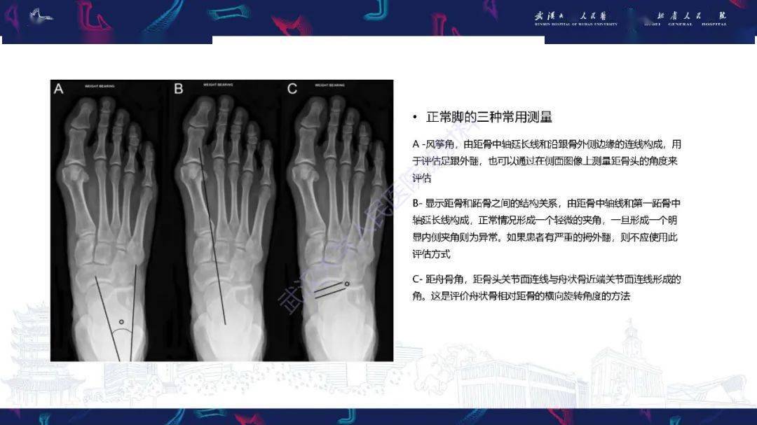 成人获得性扁平足畸形: 解剖学,生物力学,分期和影像学表现