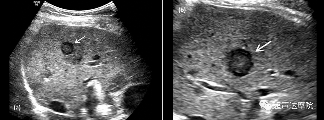 hypoechoic halo sign: liver metastases[j].