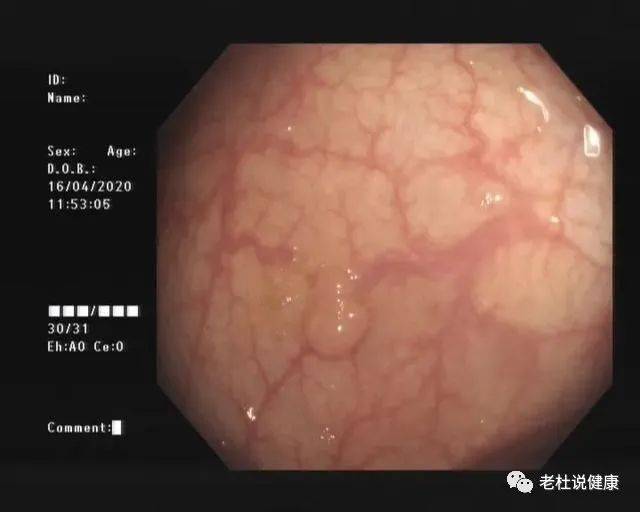 5毫米的肠息肉20年不切不查终成进展期肠癌