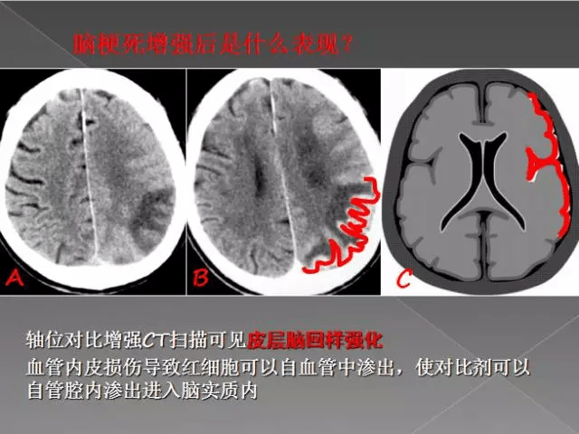 出血性脑梗死急性期及亚急性期ct呈高密度影,慢性期则逐渐呈等密度或