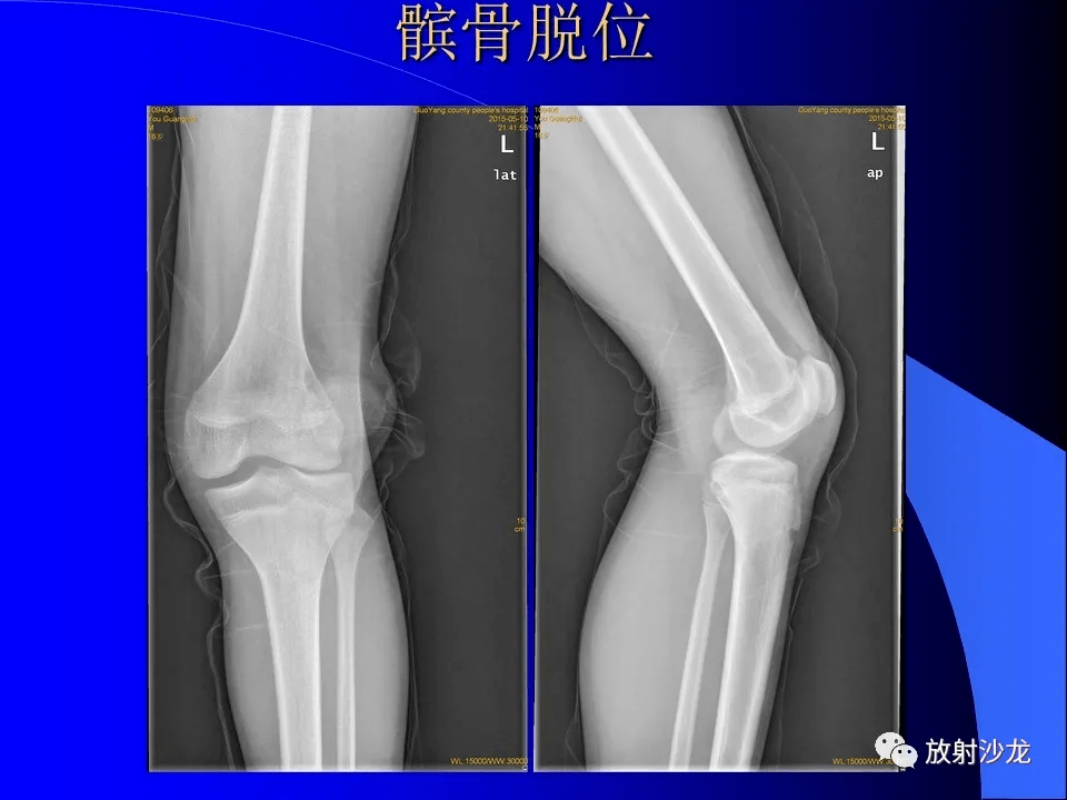 高清收藏:常见骨折/脱位的x线表现