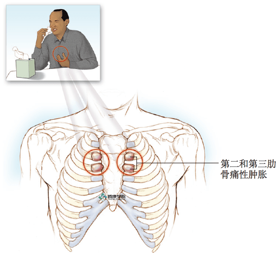 胸肋关节尤其是第二和第三关节可出现肿大并有重度压痛.