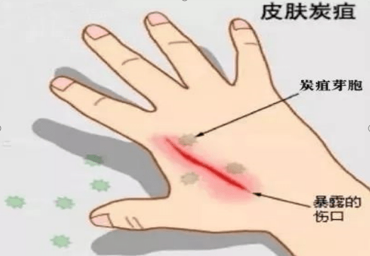 警惕炭疽!这些知识要了解