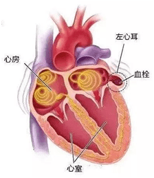 由于左心房不规律收缩,左心房内皮容易受损,加上左心房增大和左心室射