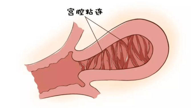 宫腔粘连临床诊疗中国专家共识(下)