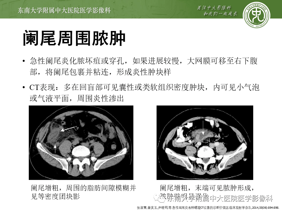 阑尾炎详细ct影像表现解读