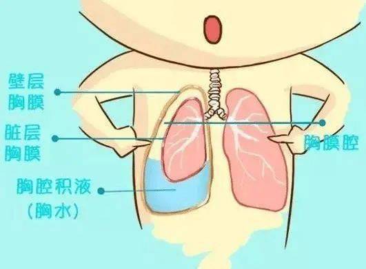 科普| 当结核菌遇到胸膜