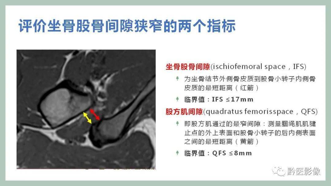 坐骨股骨撞击综合征(ischio-femoral impingement, ifi)影像学诊断