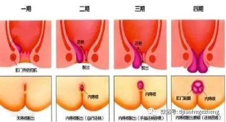 肛门视诊主要检查有无外痔及脱出的内痔(紫红色柔软肿块);肛门指诊是