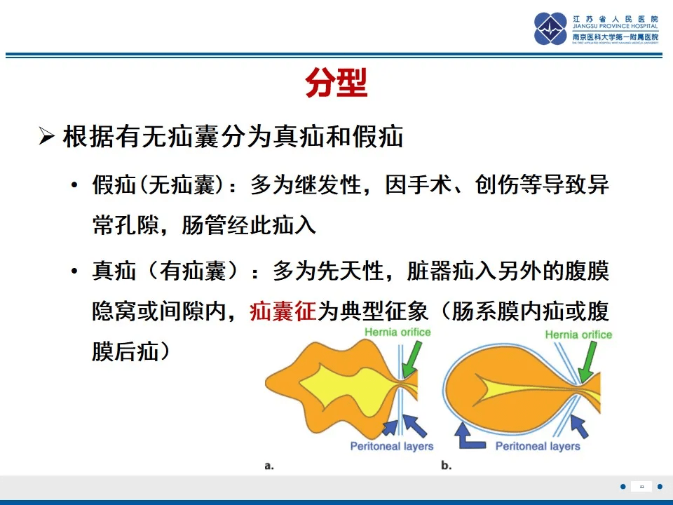 详解腹内疝分型与影像表现