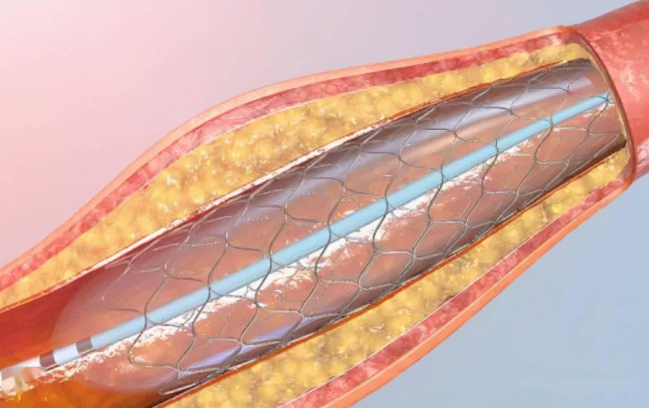 装心脏支架到底能活多久汇总支架的20个焦点误区
