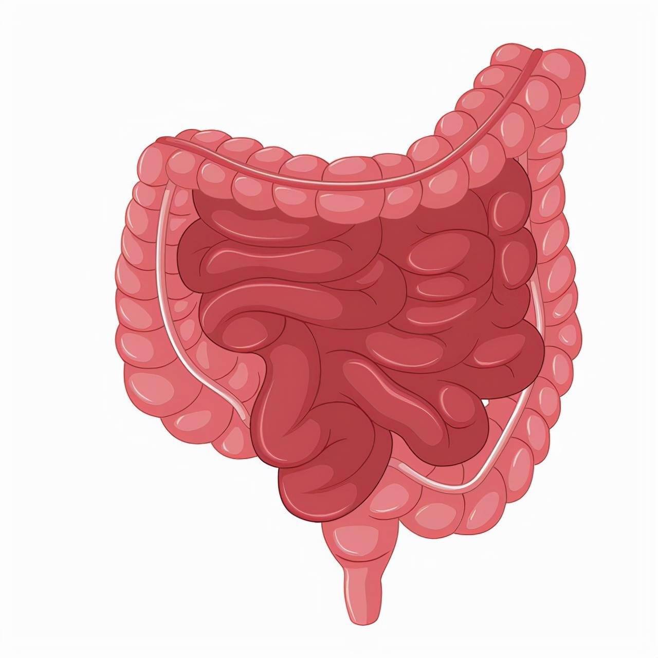 肠道癌肿逐渐增大,可部分或完全阻塞肠腔,产生不完全性或完全性肠