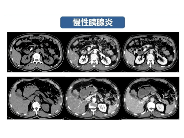 【省立影像读片】胰腺病变 21.09