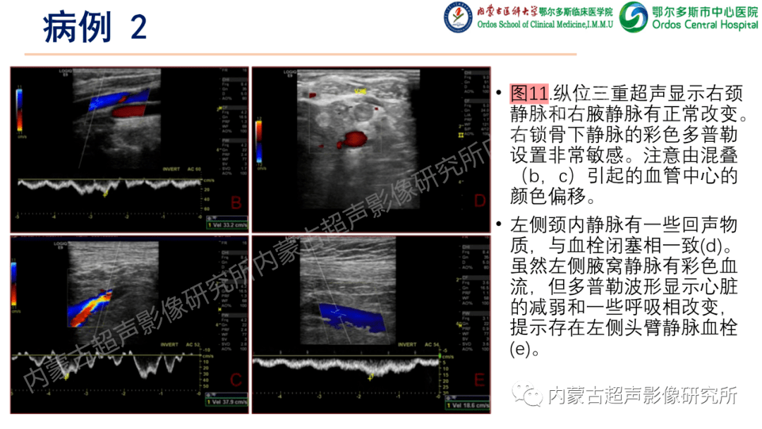 上肢深静脉血栓的超声检查.