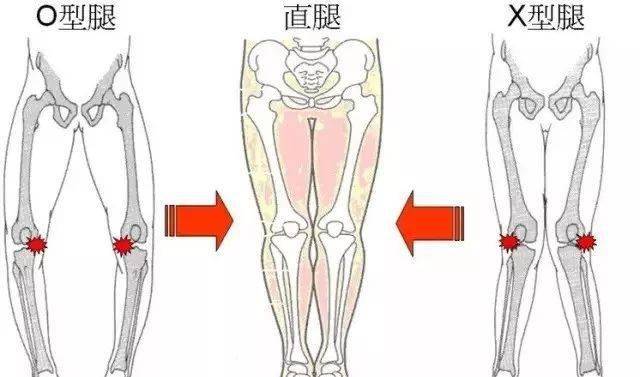 o型腿矫正弯腿变美腿