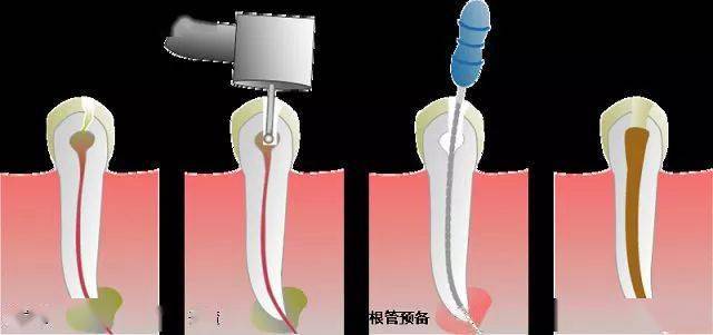 热牙胶充填10个不可不知的注意事项