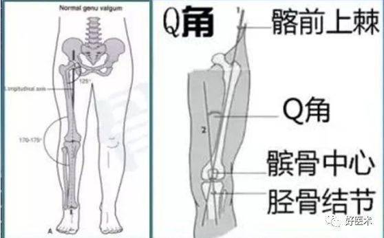 q角:从髂前上棘到髌骨中点连线代表股四头肌牵拉力线,从髌骨中点到